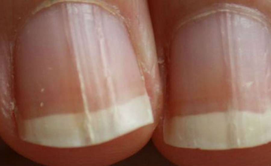 TounsiaNet : Remèdes maison contre les champignons des ongles